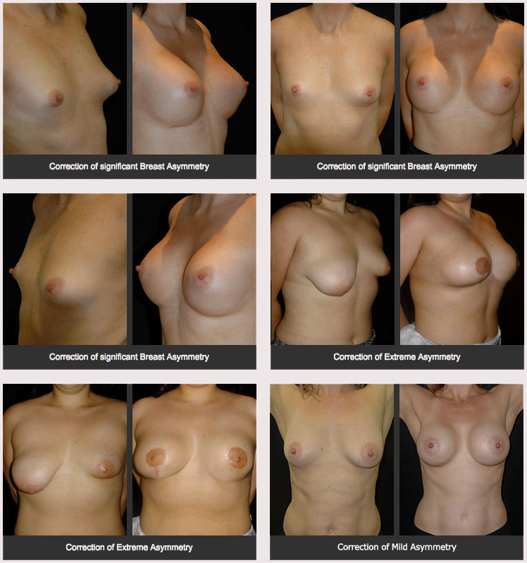 Before and after photos of breast asymmetry correction