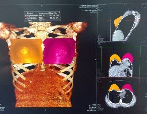 CT Scan of Breast Asymmetry Correction