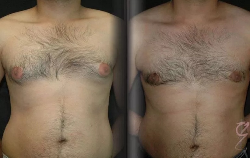 Gynaecomastia at Suite 1 Level 1 376 New South Head Road Double Bay NSW 2028 Male Breast Reduction Surgery (Gynaecomastia) - 3