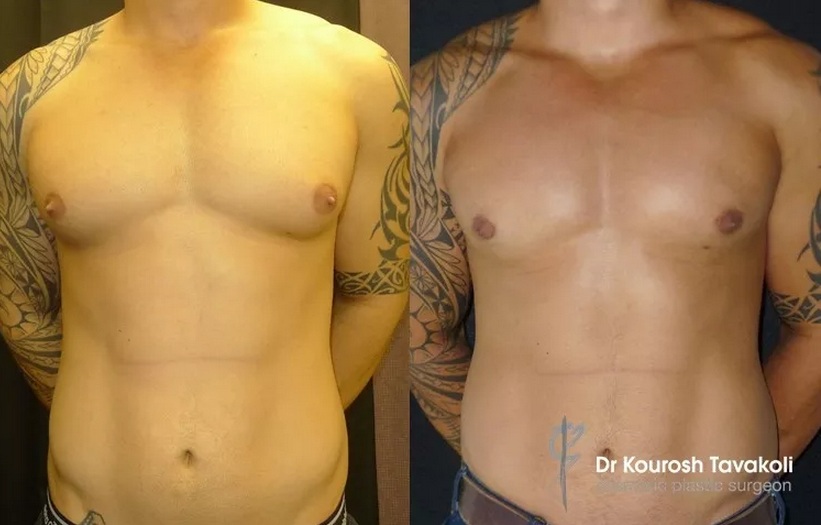 Male Breast Reduction in Sydney NSW 2028 Male Breast Reduction Surgery (Gynaecomastia) - 2