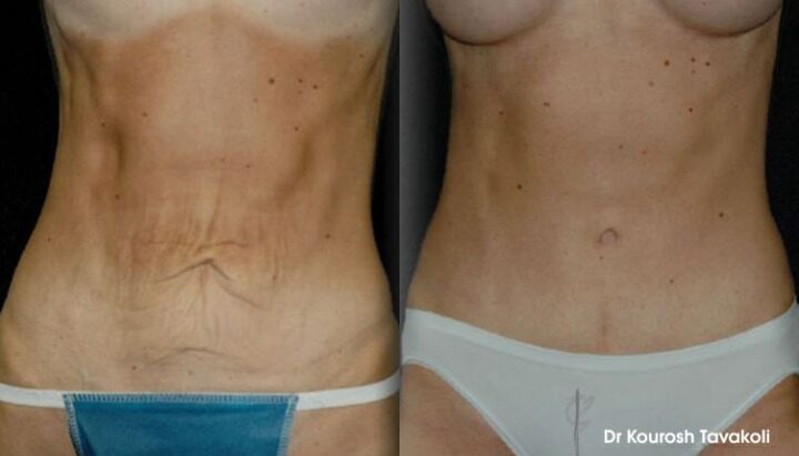 Abdominoplasty (Tummy Tuck) - Before and After Gallery - Dr Tavakoli