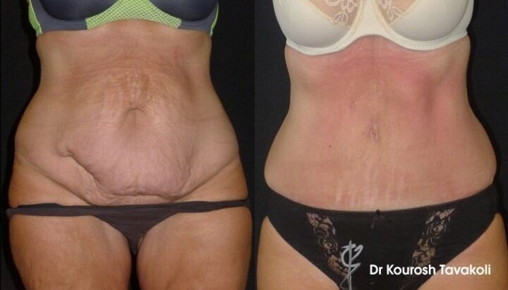 Tummy Tuck Before & After Gallery: Patient 2