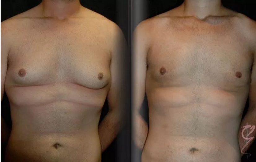 male breast reduction surgery in Sydney NSW 2028 Male Breast Reduction Surgery (Gynaecomastia) - 1